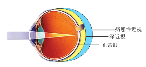 剧烈运动还会导致视网膜脱落？高度近视人群要小心了