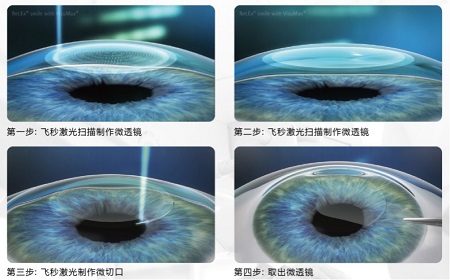 全飞秒激光近视矫正手术