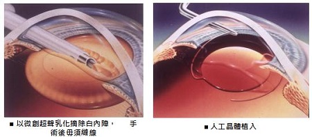 白内障手术