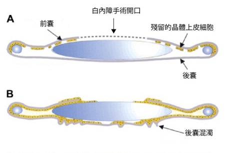 后囊混浊