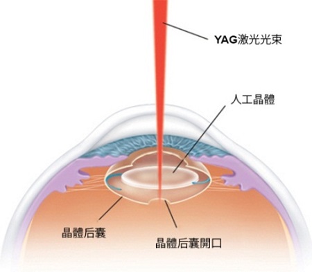 YAG激光治疗