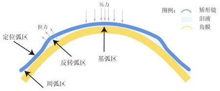 角膜塑形镜原理