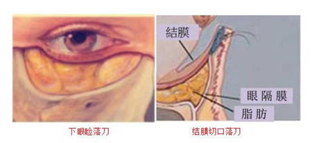 眼袋手术