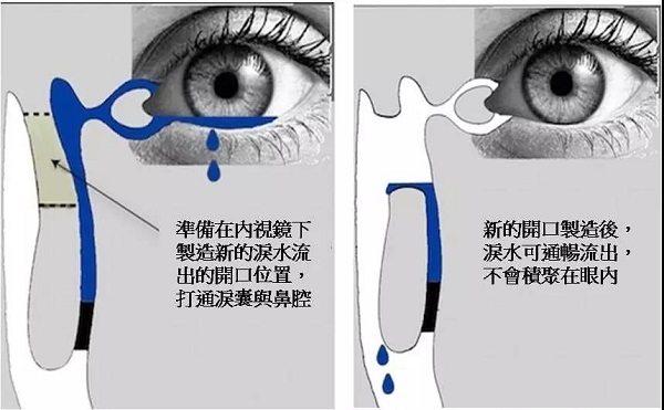 别让冷空气变成泪道病的“导火线”！