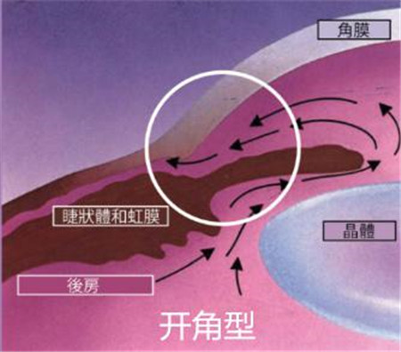 开角型青光眼