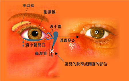 泪囊发炎