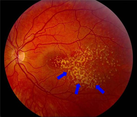 干性黄斑退化