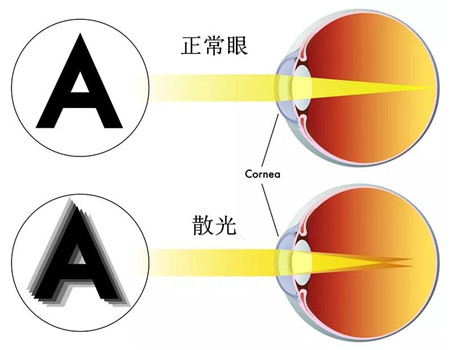 正常眼和散光眼的区别