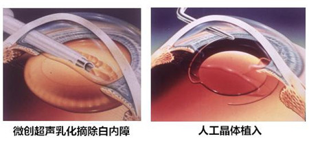 白内障手术