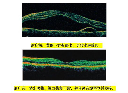 中浆激光治疗