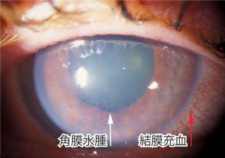 青光眼角膜水肿