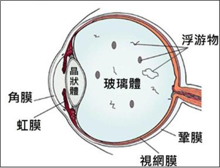 飞蚊症是怎么回事