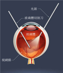 玻璃体切除术治疗飞蚊