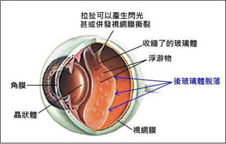 玻璃体脱落