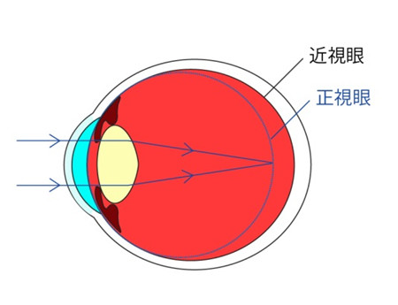 近视是怎么形成的