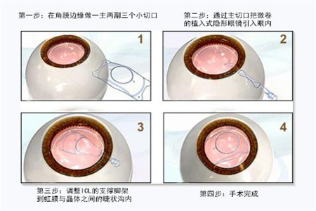 ICL晶体移植手术