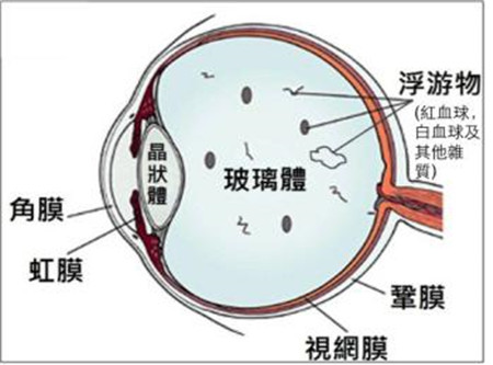 视网膜病变的症状