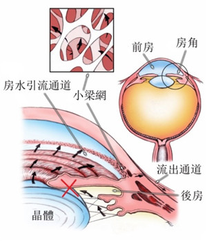 白内障可导致青光眼