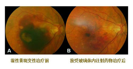 黄斑变性可以治好吗