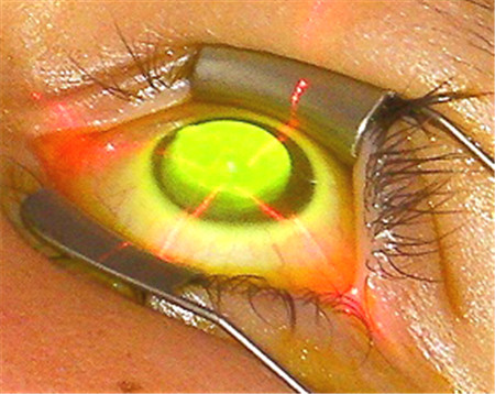 青光眼的典型临床表现 北京眼科医院