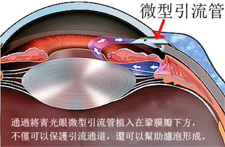 青光眼引流管手术