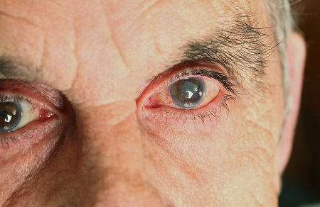 青光眼对视力的影响