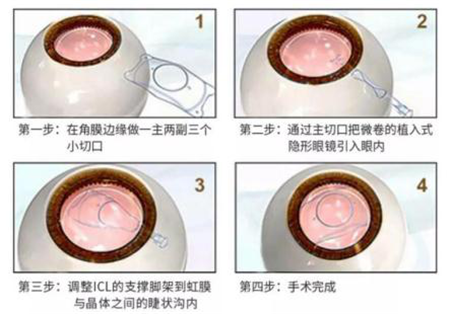 ICL晶体植入手术