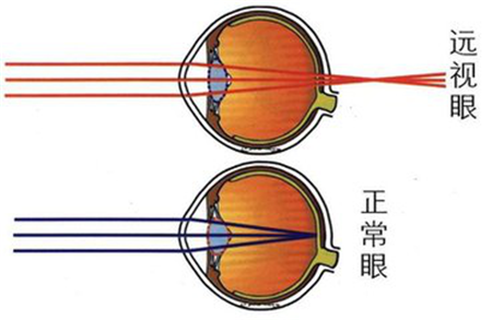 远视形成的原因