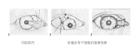 翼状胬肉切除手术