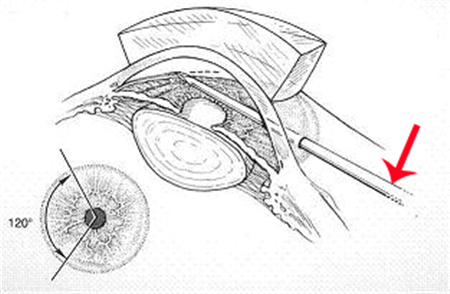 房角切开手术
