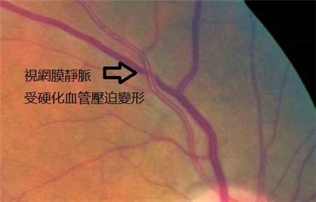 视网膜血管病变