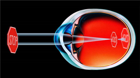 近视,眼球变形,近视加深,近视手术,角膜塑形镜