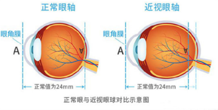 高度近视的危害