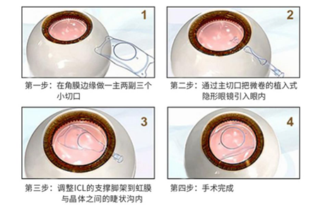 icl晶体植入手术