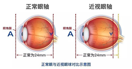 高度近视者眼轴长