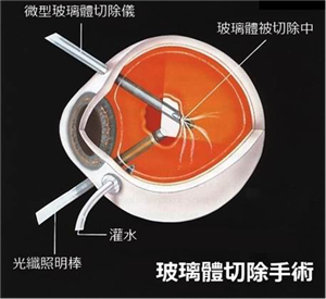 北京视网膜脱落手术