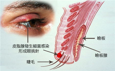 麦粒肿,针眼,麦粒肿治疗,预防麦粒肿
