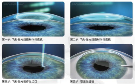 北京希玛眼科医院做全飞秒吗