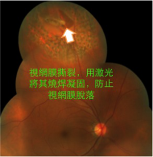 视网膜撕裂治疗
