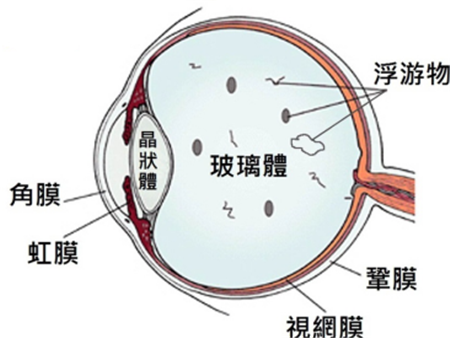 飞蚊症是什么原因引起的