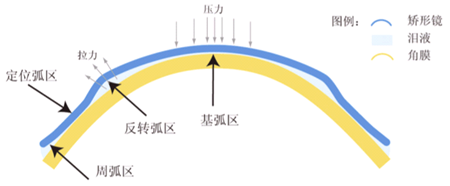 ok镜是如何矫正视力的？