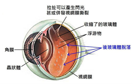 飞蚊症的成因