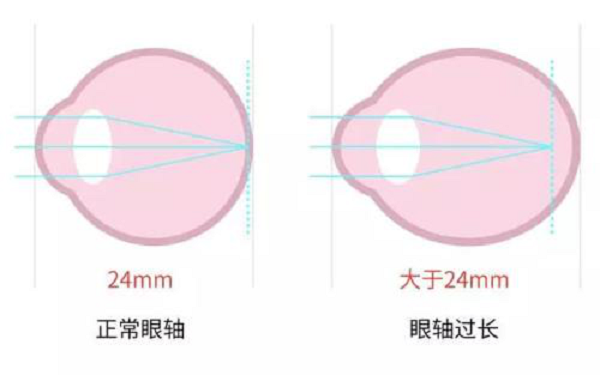 近视就不会患上老花眼?近视的你别等老花找上门才了解真相!