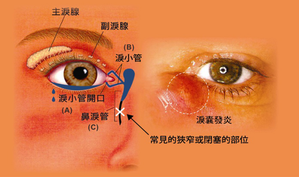 眼中常含泪水却不是因为伤心?那就有可能是因为这个原因!