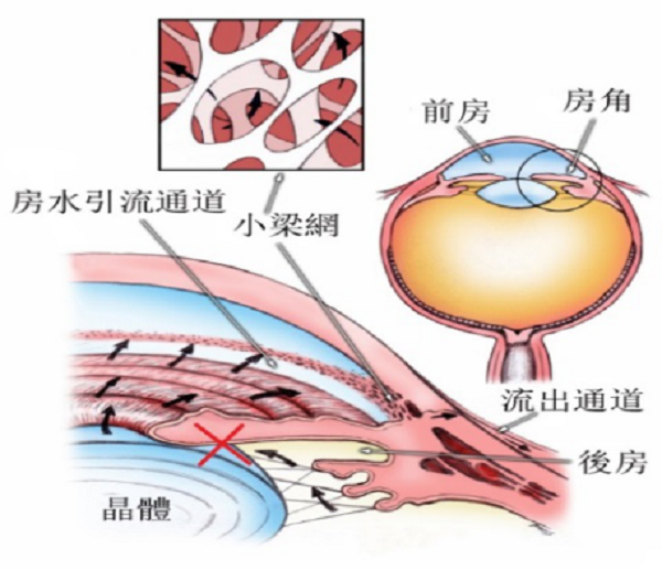 青光眼和白内障，这对难兄难弟是如何互相影响的?