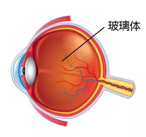 高度近视为什么会引起视网膜脱落呢？