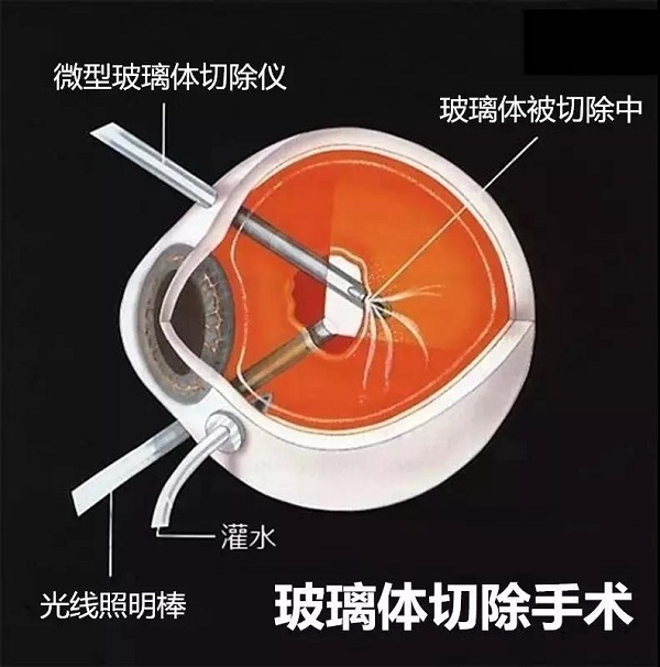高度近视为什么会引起视网膜脱落呢？