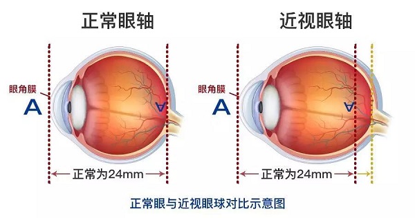 高度近视为什么会引起视网膜脱落呢？