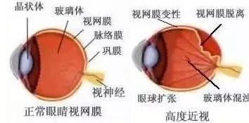 你真的了解视网膜吗？如果视网膜脱落可以这样治疗！