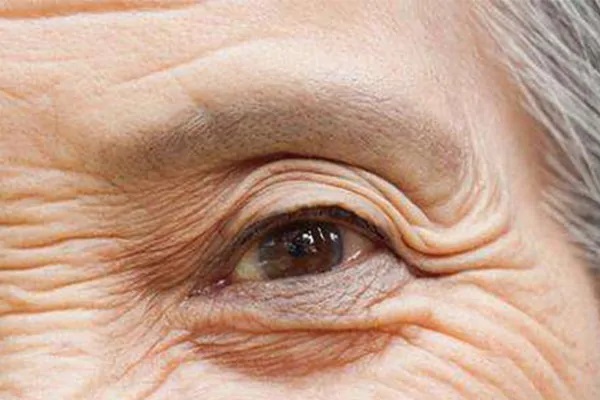 老年人容易得白内障的因素有哪些？